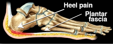 Heel and arch pain