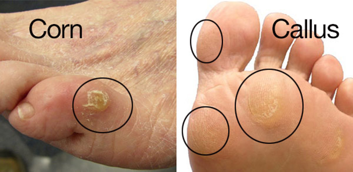 Painful hard skin on bottom best sale of foot