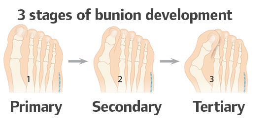 3 stages of Bunion development on the foot