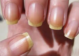 Nails with yellow discolouration