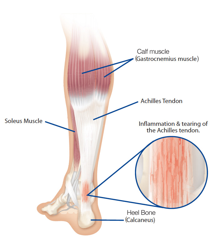 Achilles Tendonitis - Heel Pain