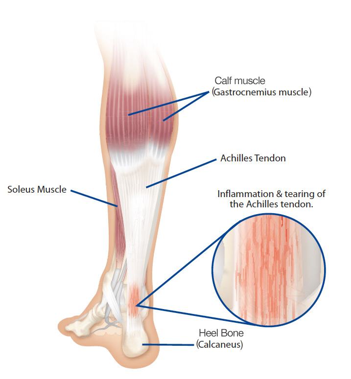 Heel and achilles on sale pain