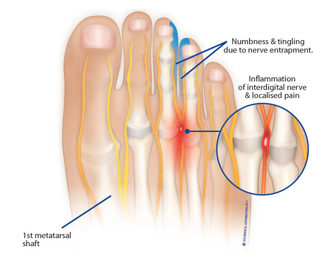 Mortons Neuroma