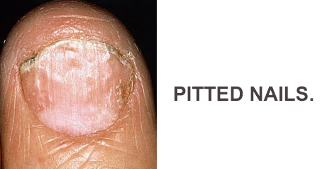 Pitted Nails