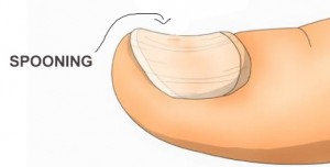 What are Spoon shaped Nails? – Feetlife Foot and nail care