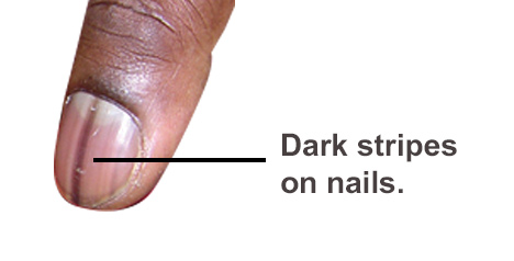 Dark Stripes On Nails