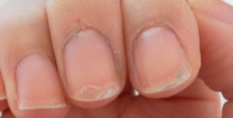 Do you suffer with splitting, brittle nails? | Feetlife Foot and Nail Care
