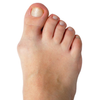 stage-one-bunion