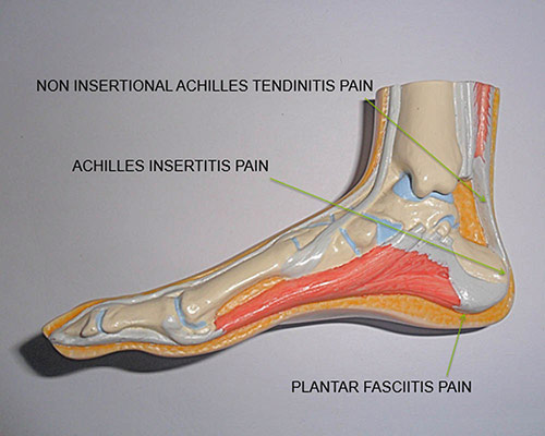 Plantar Fasciitis and Heel Pain