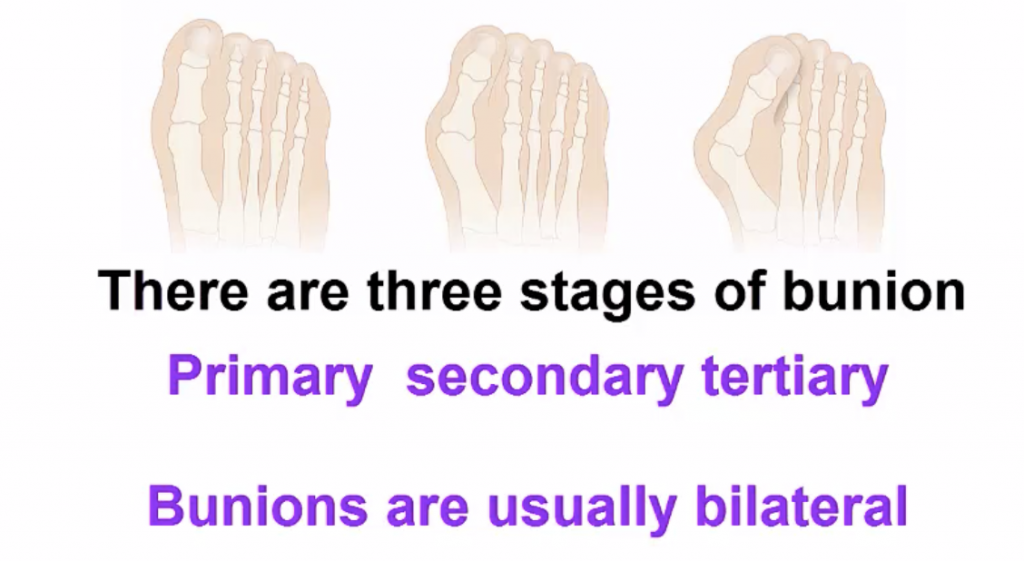 Bunion Pain Treatment and Causes Feetlife Foot and Nail Care