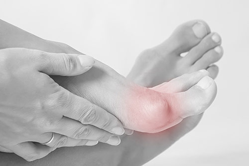 Bunion foot pain